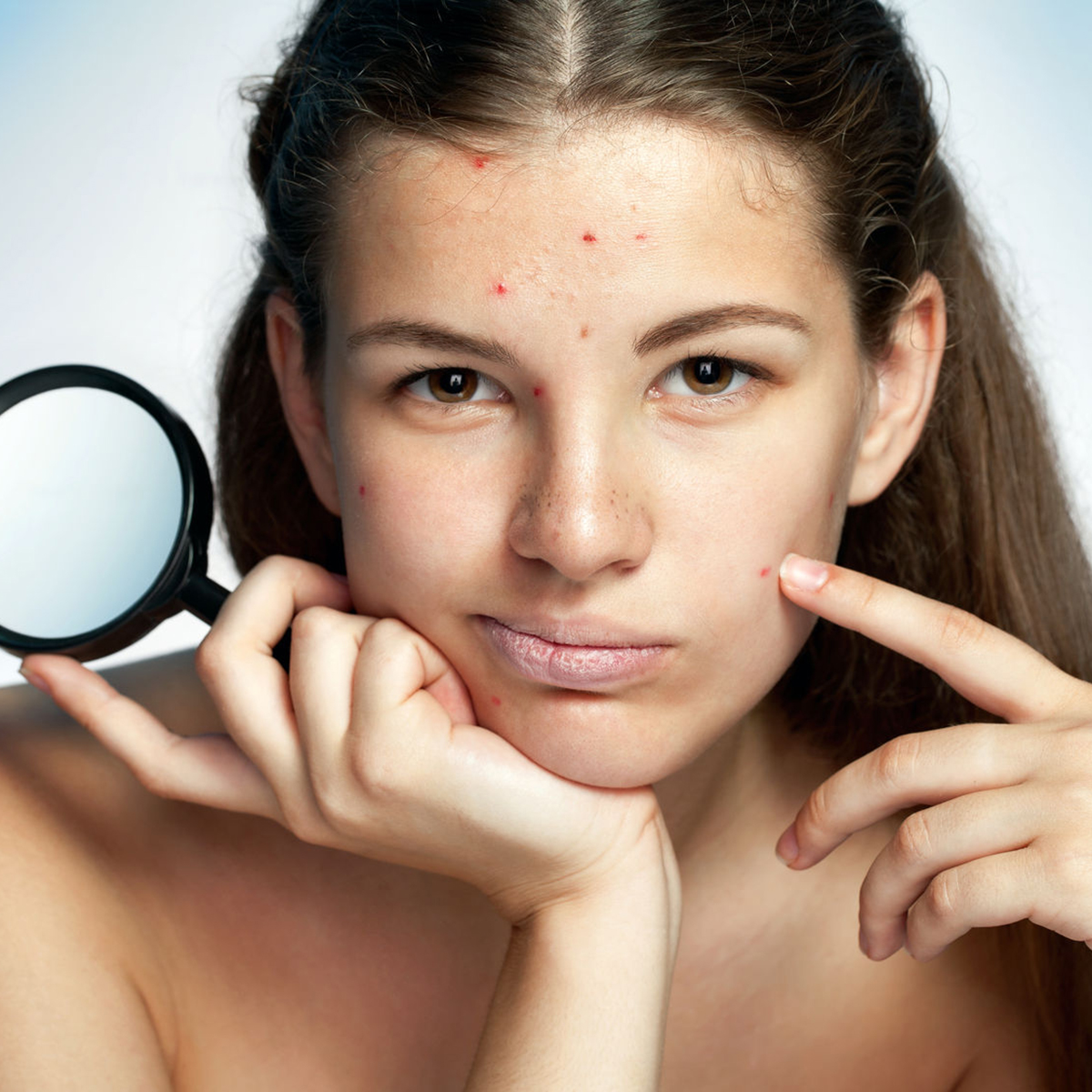chica-acne