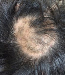 alopecia-2
